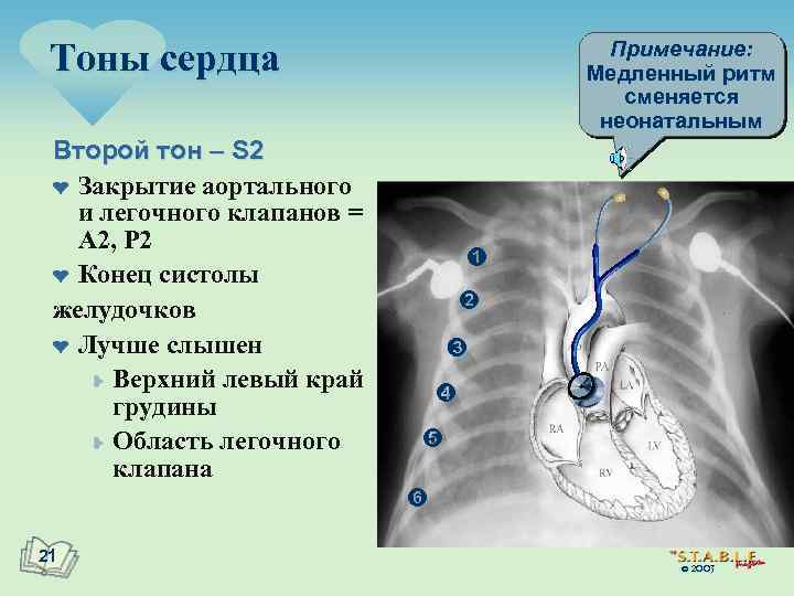 Тоны сердца Примечание: Медленный ритм сменяется неонатальным Второй тон – S 2 ¤ Закрытие