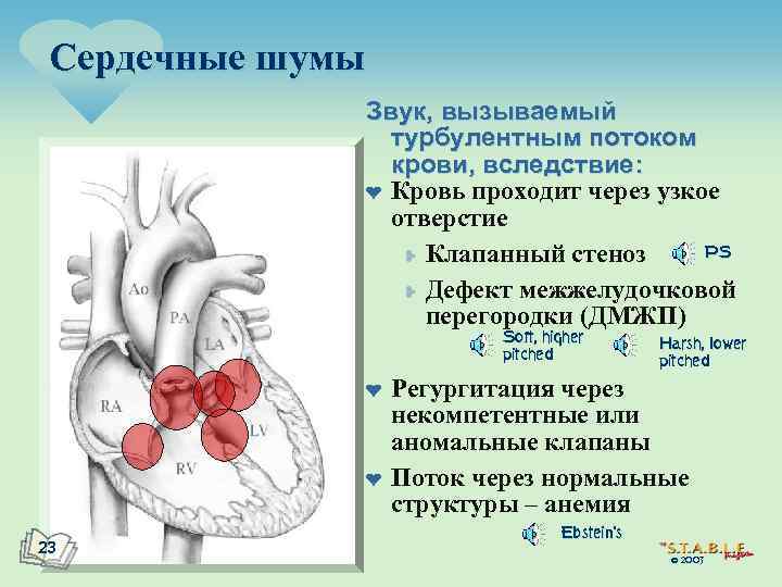 Сердечные шумы Звук, вызываемый турбулентным потоком крови, вследствие: ¤ Кровь проходит через узкое отверстие