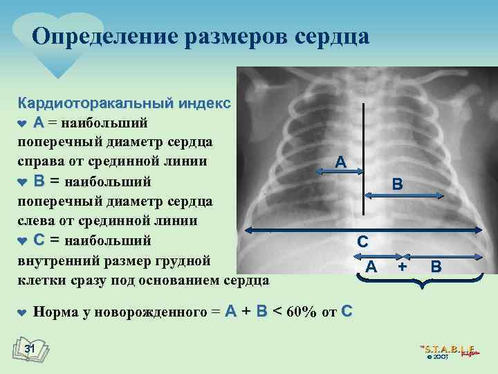 Определение размеров сердца Кардиоторакальный индекс ¤ A = наибольший поперечный диаметр сердца справа от