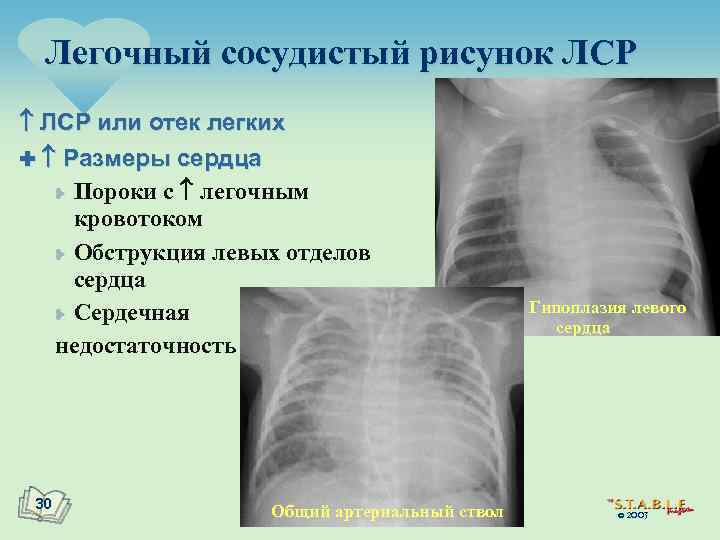 Усилен сосудистый рисунок легких что это