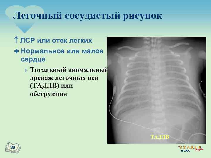 Усиление сосудистого рисунка легких