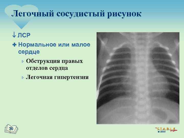 Легочный сосудистый рисунок ЛСР : Нормальное или малое сердце ¥ Обструкция правых отделов сердца