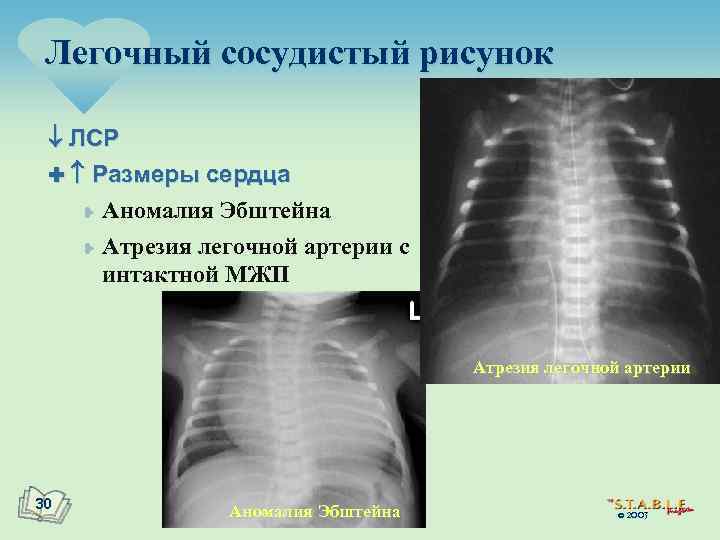 При аномалии эбштейна легочный рисунок