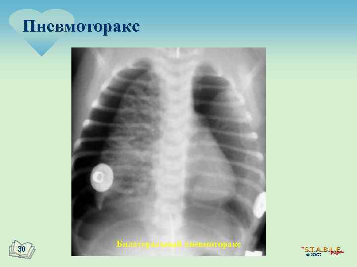 Пневмоторакс 30 Билатеральный пневмоторакс © 2003 