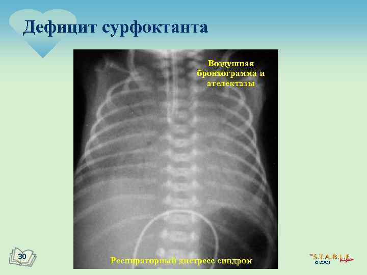 Дефицит сурфоктанта Воздушная бронхограмма и ателектазы 30 Респираторный дистресс синдром © 2003 