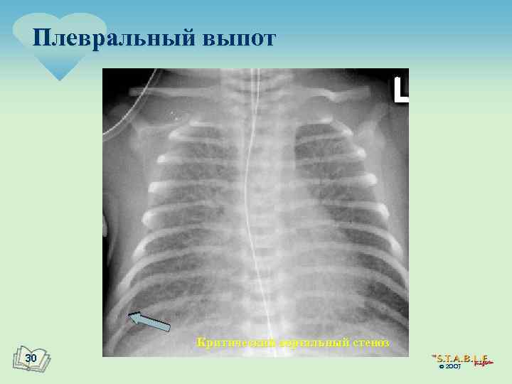 Плевральный выпот Критический аортальный стеноз 30 © 2003 