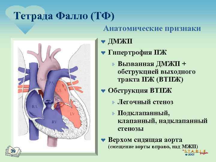 Тетрада Фалло (ТФ) Анатомические признаки ¤ ДМЖП ¤ Гипертрофия ПЖ ¥ ¤ Обструкция ВТПЖ