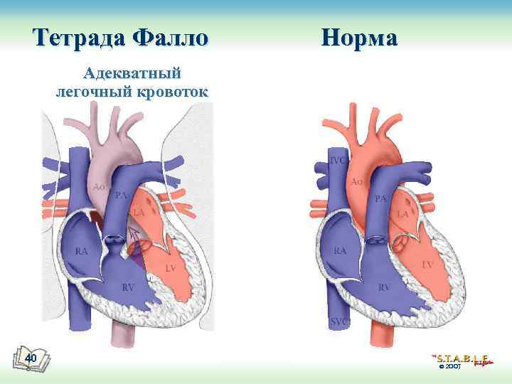 Тетрада Фалло Норма Адекватный легочный кровоток 40 © 2003 