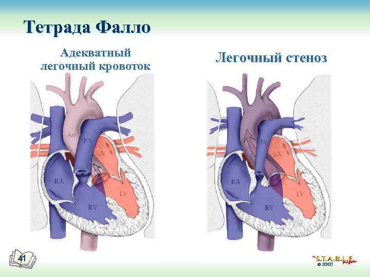 Тетрада Фалло Адекватный легочный кровоток 41 Легочный стеноз © 2003 