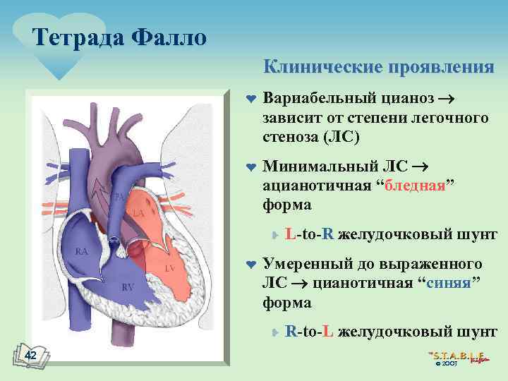 Тетрада фалло клиническая картина