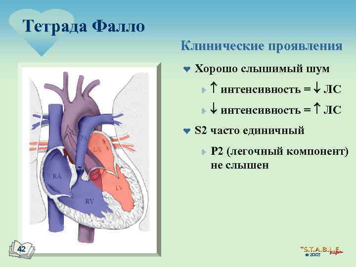 Тетрада Фалло Клинические проявления ¤ Хорошо слышимый шум ¥ ¥ ¤ интенсивность = ЛС