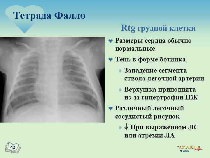 Тетрада Фалло Rtg грудной клетки ¤ ¤ Размеры сердца обычно нормальные Тень в форме