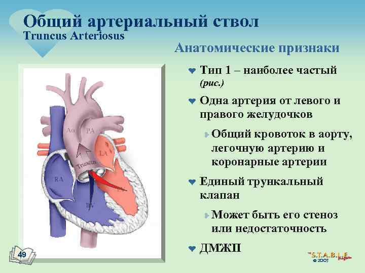 Общий артериальный ствол Truncus Arteriosus Анатомические признаки ¤ Тип 1 – наиболее частый (рис.