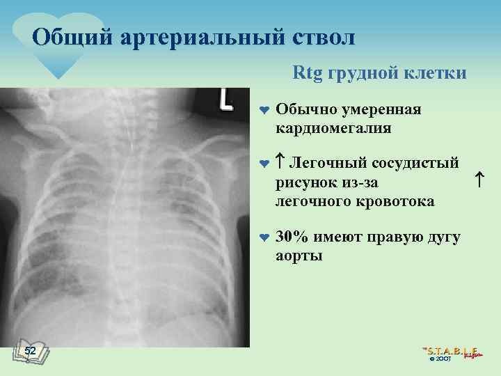 Общий артериальный ствол Rtg грудной клетки ¤ ¤ ¤ 52 Обычно умеренная кардиомегалия Легочный