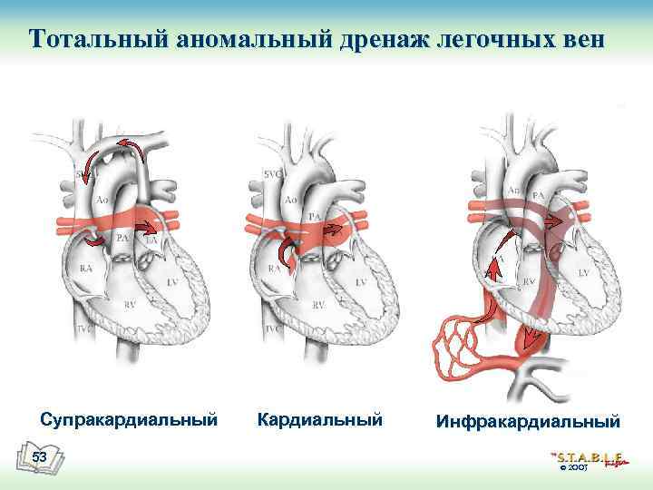 Тотальный аномальный дренаж легочных вен Супракардиальный 53 Кардиальный Инфракардиальный © 2003 