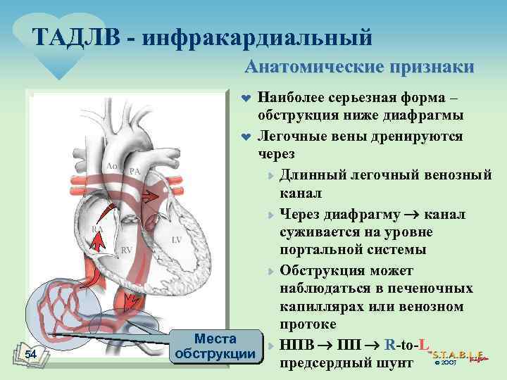 ТАДЛВ - инфракардиальный Анатомические признаки Наиболее серьезная форма – обструкция ниже диафрагмы ¤ Легочные