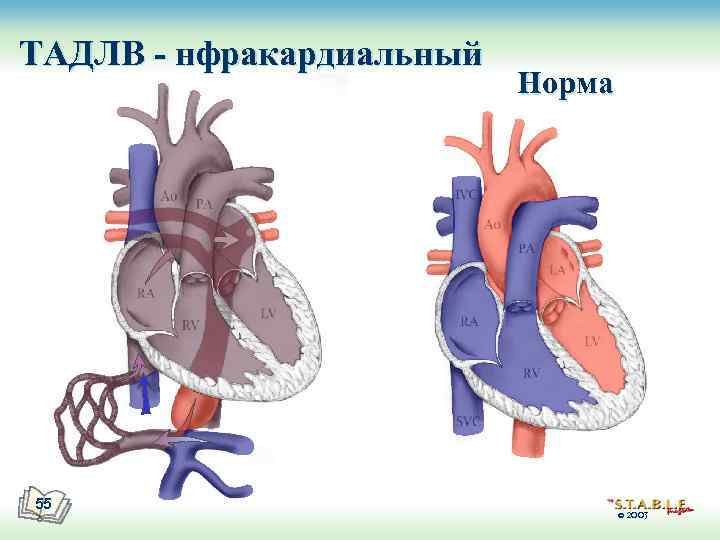 ТАДЛВ - нфракардиальный 55 Норма © 2003 