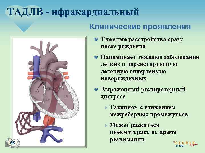 ТАДЛВ - нфракардиальный Клинические проявления ¤ ¤ ¤ Тяжелые расстройства сразу после рождения Напоминает