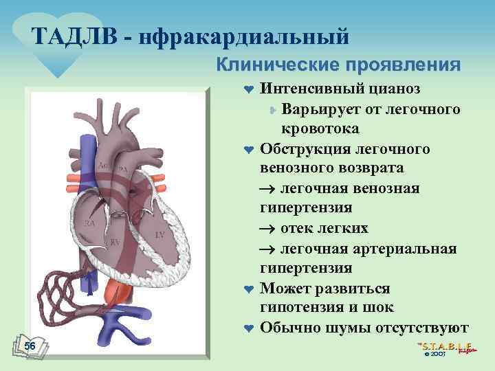 ТАДЛВ - нфракардиальный Клинические проявления ¤ ¤ 56 Интенсивный цианоз ¥ Варьирует от легочного