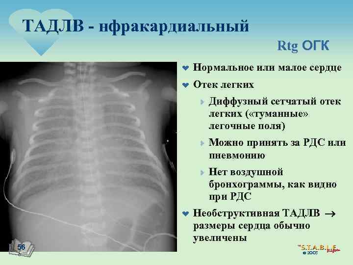 Огк это. Направление на рентген ОГК. Рентген при ТАДЛВ. Конфигурация сердца при отеке легких.