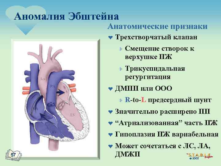 Аномалия Эбштейна Анатомические признаки ¤ Трехстворчатый клапан ¥ ¥ ¤ Смещение створок к верхушке