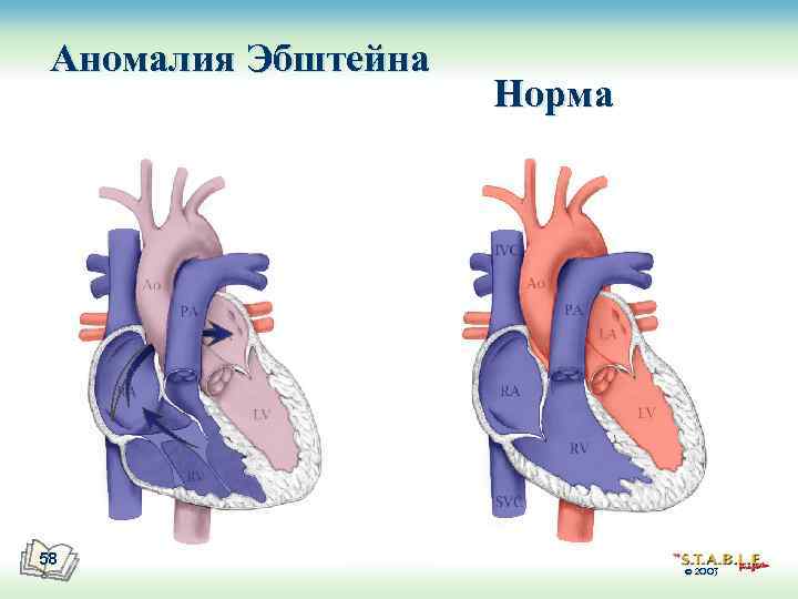 Аномалия эбштейна фото