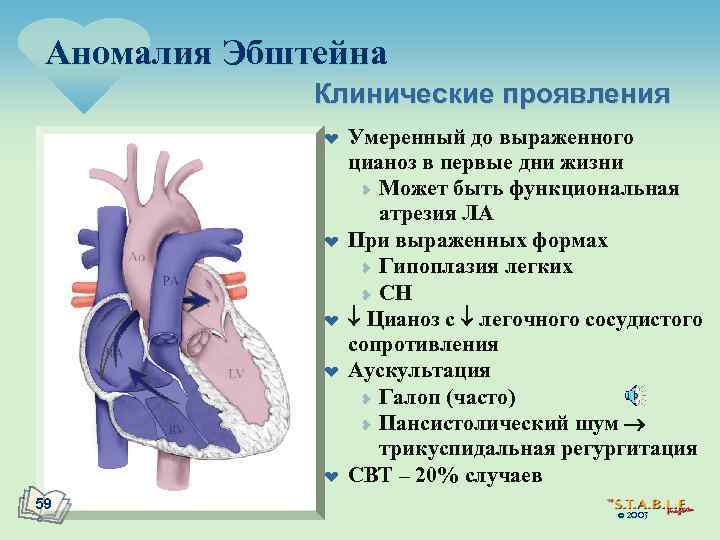 Аномалия Эбштейна Клинические проявления ¤ ¤ ¤ 59 Умеренный до выраженного цианоз в первые