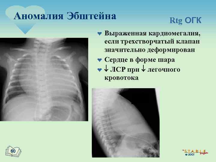 Аномалия Эбштейна ¤ ¤ ¤ 60 Rtg ОГК Выраженная кардиомегалия, если трехстворчатый клапан значительно