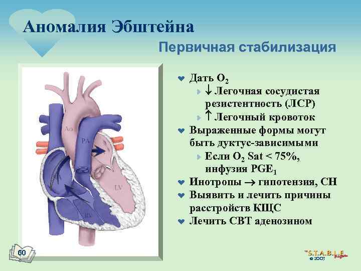 Аномалия Эбштейна Первичная стабилизация ¤ ¤ ¤ 60 Дать O 2 ¥ Легочная сосудистая