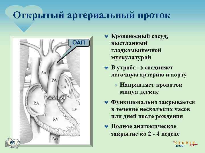 Схема открытого артериального протока