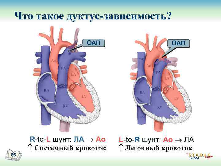 Что такое дуктус-зависимость? ОАП R-to-L шунт: ЛА Ao Системный кровоток 65 ОАП L-to-R шунт: