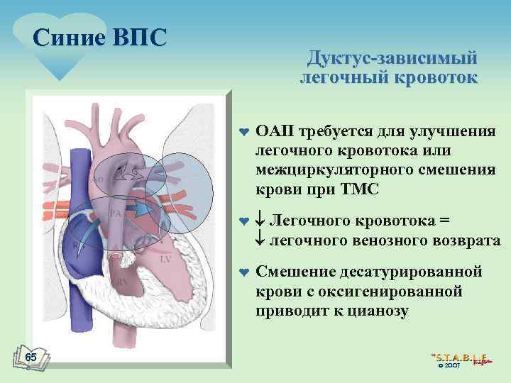 Синие ВПС Дуктус-зависимый легочный кровоток ¤ ¤ ¤ 65 ОАП требуется для улучшения легочного