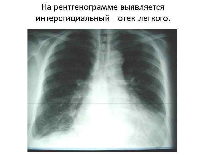 На рентгенограмме выявляется интерстициальный отек легкого. 