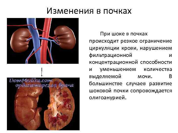 Изменения в почках При шоке в почках происходит резкое ограничение циркуляции крови, нарушением фильтрационной