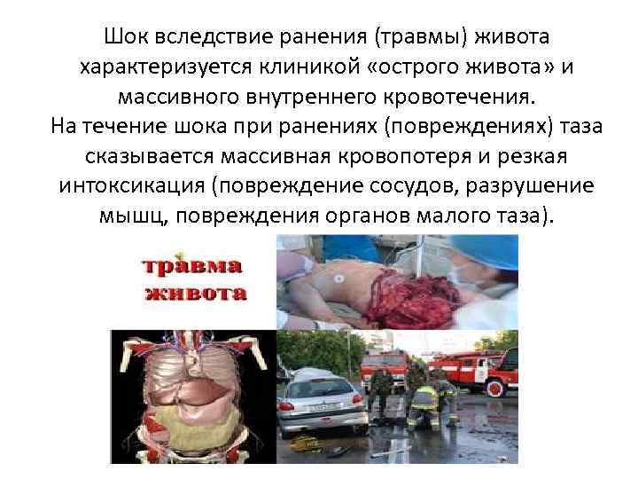 Шок вследствие ранения (травмы) живота характеризуется клиникой «острого живота» и массивного внутреннего кровотечения. На