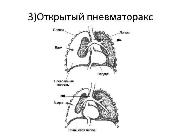 3)Открытый пневматоракс 