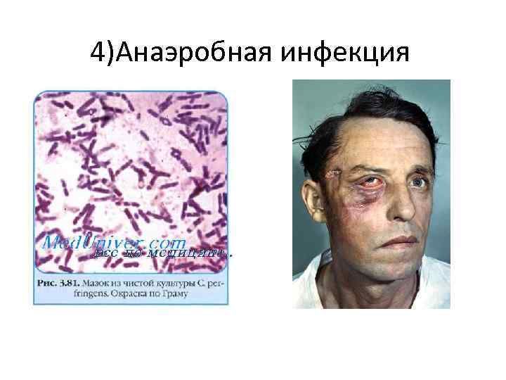 4)Анаэробная инфекция 