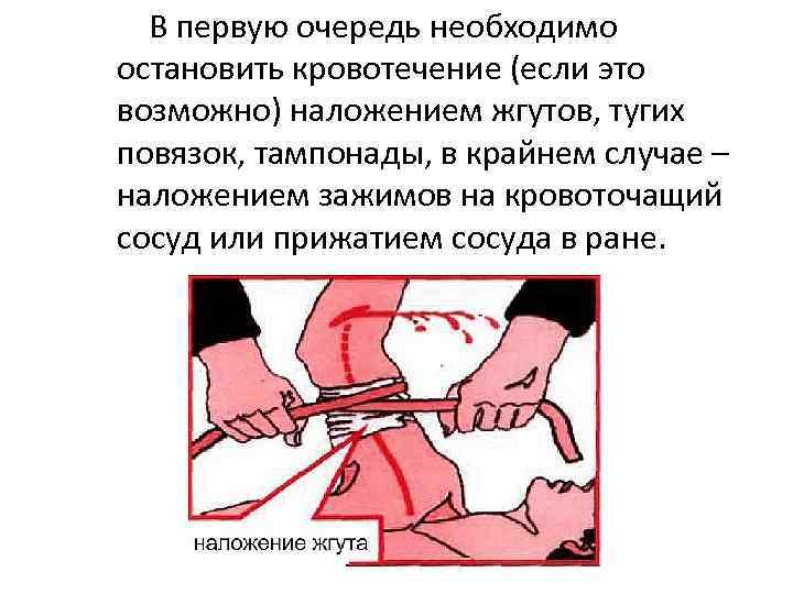  В первую очередь необходимо остановить кровотечение (если это возможно) наложением жгутов, тугих повязок,