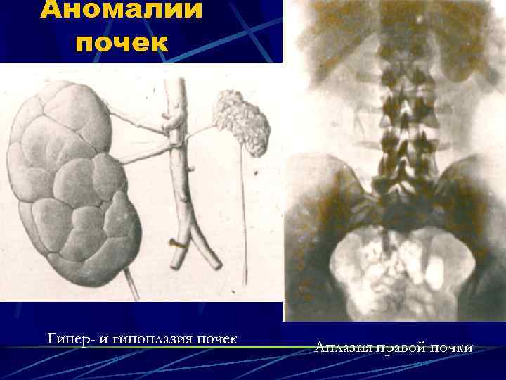 Аномалии почек Гипер- и гипоплазия почек Аплазия правой почки 