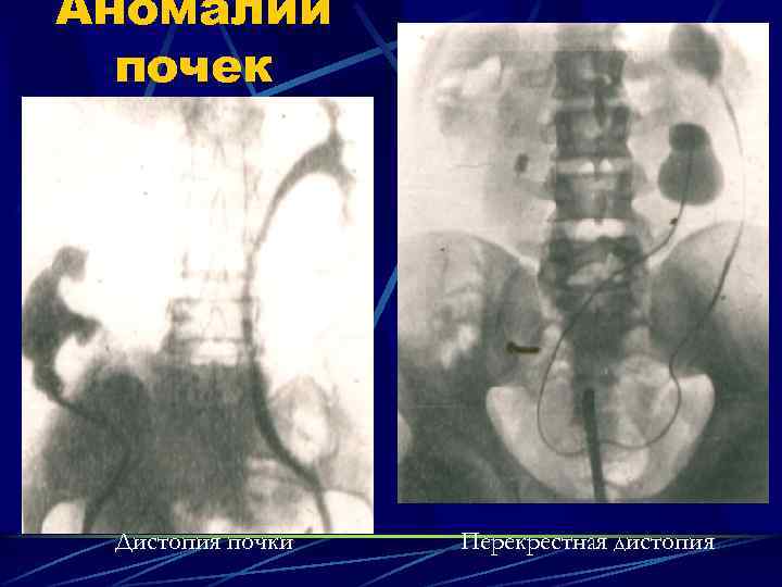 Аномалии почек Дистопия почки Перекрестная дистопия 