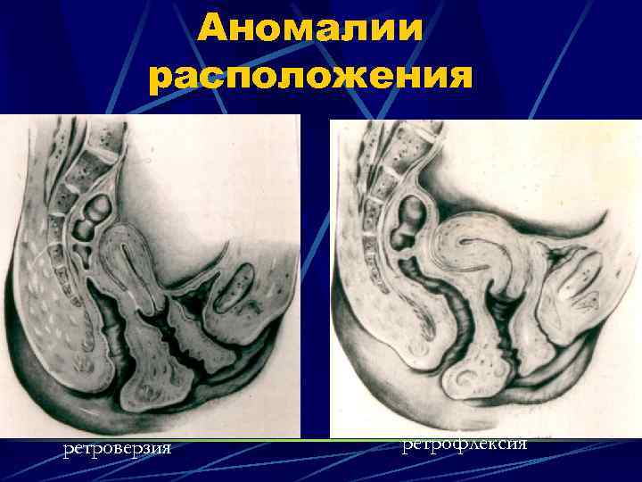 Аномалии расположения ретроверзия ретрофлексия 