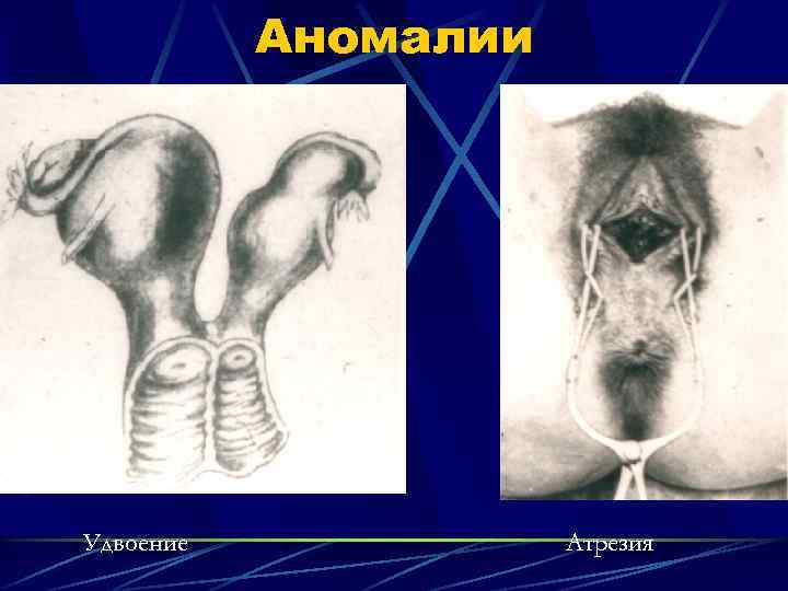 Аномалии Удвоение Атрезия 