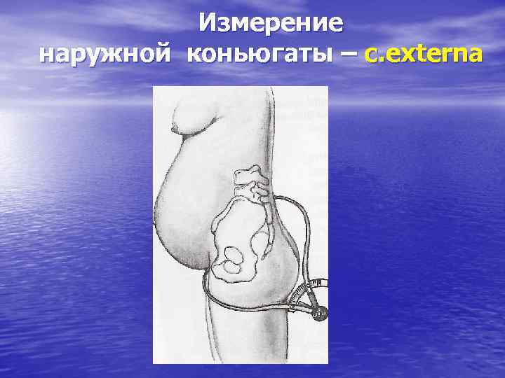 Измерение наружной коньюгаты – c. externa 