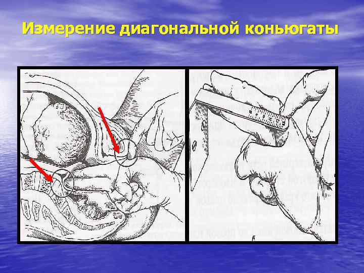 Измерение диагональной коньюгаты 