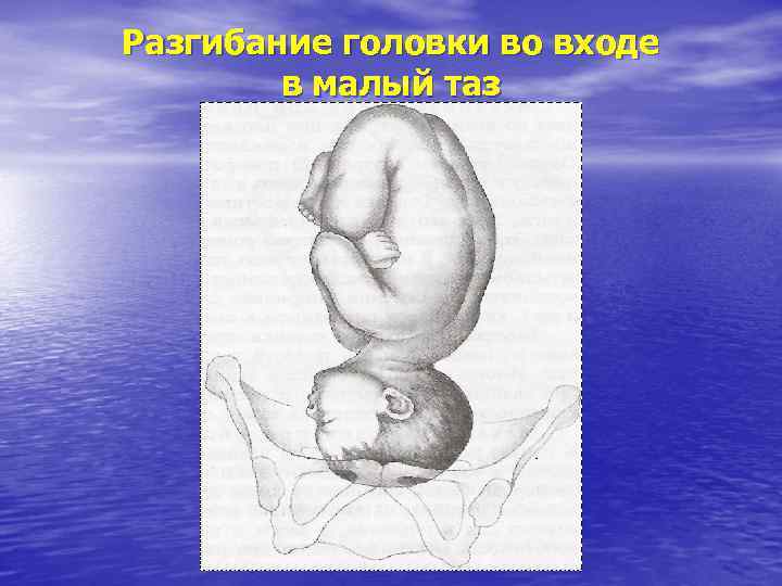 Разгибание головки во входе в малый таз 