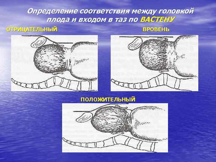 Определение соответствия между головкой плода и входом в таз по ВАСТЕНУ ОТРИЦАТЕЛЬНЫЙ ВРОВЕНЬ ПОЛОЖИТЕЛЬНЫЙ