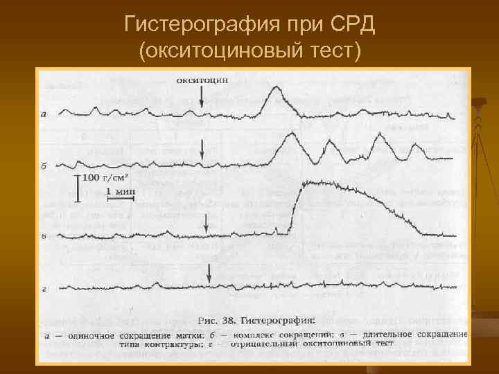 Гистерография при СРД (окситоциновый тест) 