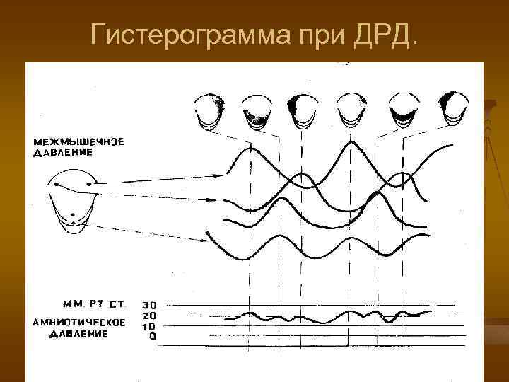 Гистерограмма при ДРД. 