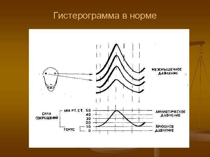 Гистерограмма в норме 