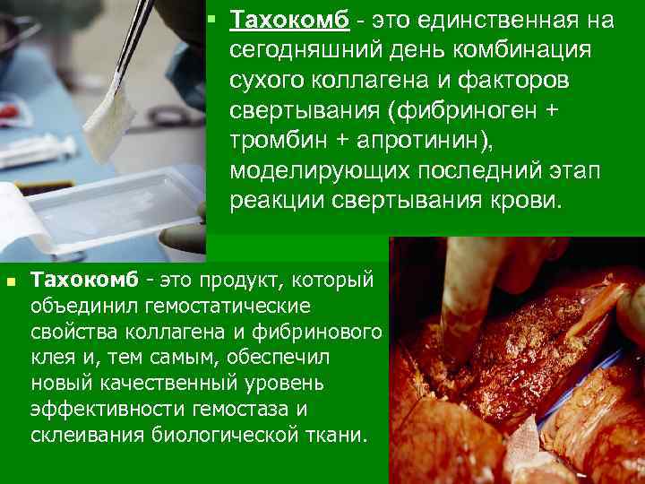 § Тахокомб - это единственная на сегодняшний день комбинация сухого коллагена и факторов свертывания